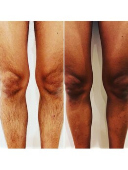 ブリッジ(BRIDGE)/男性足脱毛ビフォーアフター