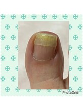 リゼラアンドコー 宇都宮店/巻き爪矯正♪B/Sスパンゲ