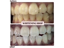 ホワイトニングショップ 明石大久保店/【BeforeAfter】