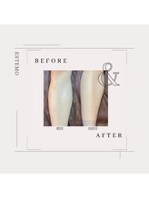 エステモ 札幌店(ESTEMO)/脚脱毛Before&After