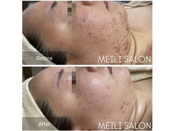 メイリー(MEILI)/ニキビケア10回効果