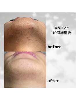 パーミル 楠葉店(per mille‰)/Before/After