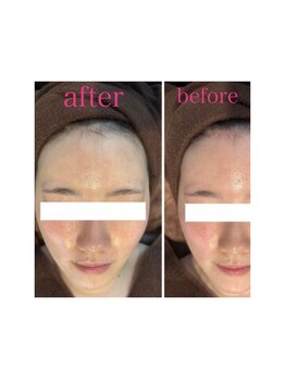 アイリス 川崎/毛穴洗浄+光フェイシャル/症例