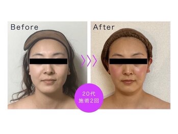 アンリール 苫小牧店(ANRIRE)/フェイシャル施術のお客様です