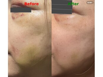 ミカド 銀座(mikado)/切開リフト/内出血・硬さ緩和