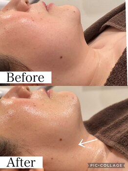 ウォーム(Warm)/フラクショナル施術例