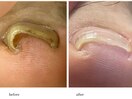 巻き爪改善ケア