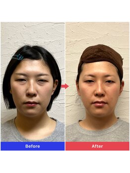 天空の手もみ/目の開き・頬骨矯正【3回目】