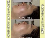 ハニエル(Haniel)/ゾンビマスク症例