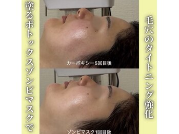 ハニエル(Haniel)/ゾンビマスク症例