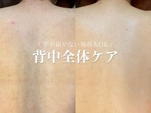 ルアナアイナ 大分/ハーブピーリング(9)