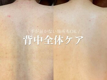 ルアナアイナ 大分/ハーブピーリング(9)