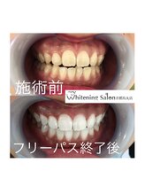 ホワイトニングサロン 京都烏丸店/ホワイトニング施術例