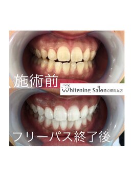 ホワイトニングサロン 京都烏丸店/ホワイトニング施術例