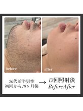 エリクサー 熊谷店(Elixir)/20代前半12回照射後