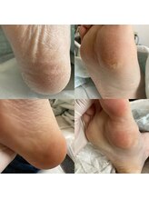 ララルアナ(Lara luana)/かかとツルツル美人