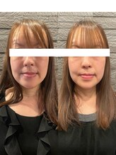 長寿鍼灸院 長寿整骨院/美容鍼100本の効果★タルミ改善