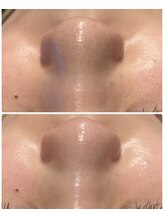 プレジール(PLAISIR)/いちご鼻撃退！ハイドラ毛穴洗浄