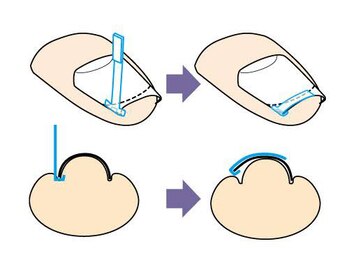 とくしま整体院 藍住院/巻き爪