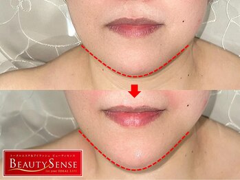 ビューティセンス 国分寺店/ビフォーアフター