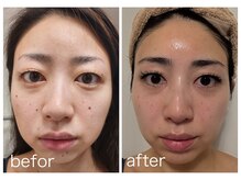 サロン ド プリリ(Salon de Puriri)/自身の変化 ホクロ除去のみ