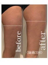 アムール 麻布十番(Amour)/エンダモロジー×ヒップアップ