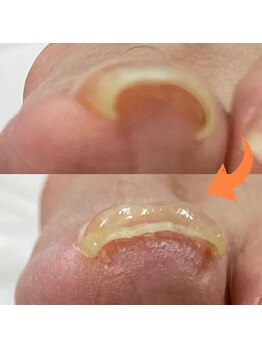 スマートリフト 五反田 大崎店(SMART LIFT)/巻き爪改善施術【大崎/五反田】