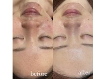 レシェルサロン(Lechelle Salon)/ハーブピーリング＋オプション