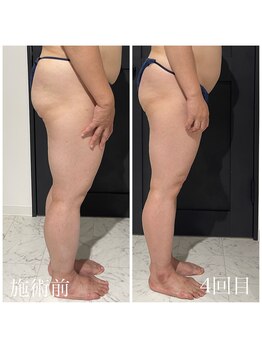 クリア(CLEAR)/リヴァイセルボディ　