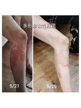 ハリス(HARIS)/肌の悩み改善に