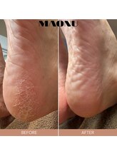 マオヌー(MAONU)/韓国式足裏角質ケア　症例写真