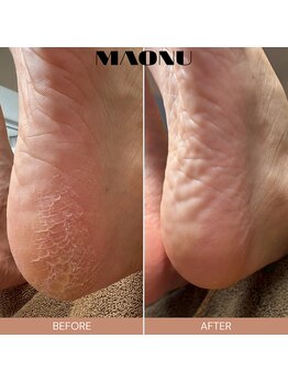 マオヌー(MAONU)/韓国式足裏角質ケア　症例写真