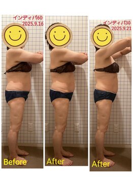 ソレイユ/インディバでお腹周りすっきり!