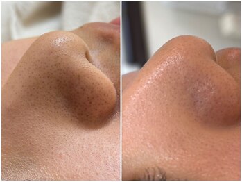 ミュー 金山店(mieux)/毛穴の黒ずみ