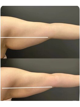 ルモラビューティー(Lumora Beauty)/二の腕ケアのビフォーアフター