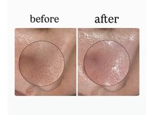 ユズドット(yuzu.)/黒ずみ毛穴に特におすすめ