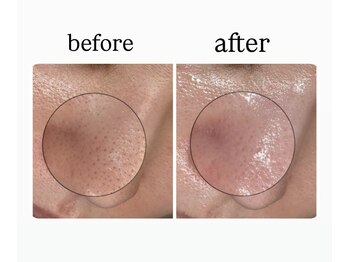 ユズドット(yuzu.)/黒ずみ毛穴に特におすすめ