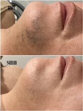 プルーラントエステ キョウト ビジョーラ(PullulantEsthe Kyoto×BEJORA)/髭脱毛