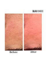 ココシア 取手店(COCOCIA)/ハーブピーリング症例★