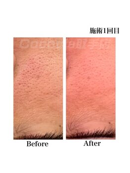 ココシア 取手店(COCOCIA)/ハーブピーリング症例★