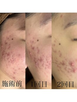 リノア 堀江(Linoa)/毛穴洗浄＆ハーブピーリング