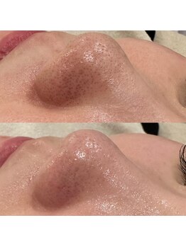 ウィール 栄 矢場町店(WE:LL)/毛穴洗浄