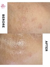 スキニティ(Skinity)/ハーブピーリング１回目