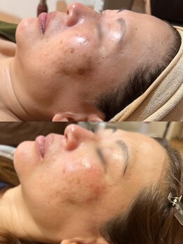 モアナ(Moana)/シミケア