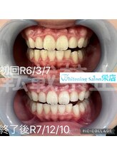 ホワイトニングサロン 名古屋 栄店/【ホワイトニング】