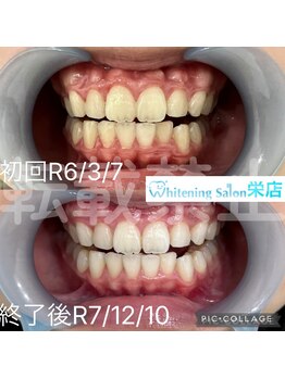 ホワイトニングサロン 名古屋 栄店/【ホワイトニング】