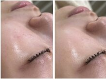 スムース イー(Smooth+E)の雰囲気（マイクロニードルで肌のキメアップ　毛穴引き締めたるみ引き上げ）