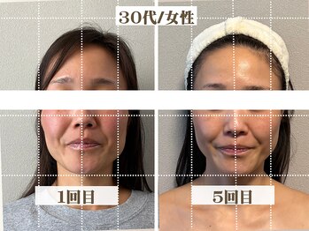 コガオラボ 甲府店(KOGAO LABO)/お客様☆Before&After☆