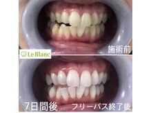 ルブラン 奈良店(Le Blanc)/たったの7日間！14回照射！