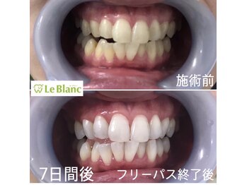 ルブラン 奈良店(Le Blanc)/たったの7日間!14回照射!